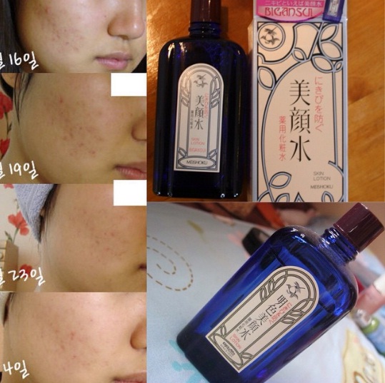 Nuoc hoa hong dac tri mun Meishoku Bigansui Medicated Skin Lotion (2)